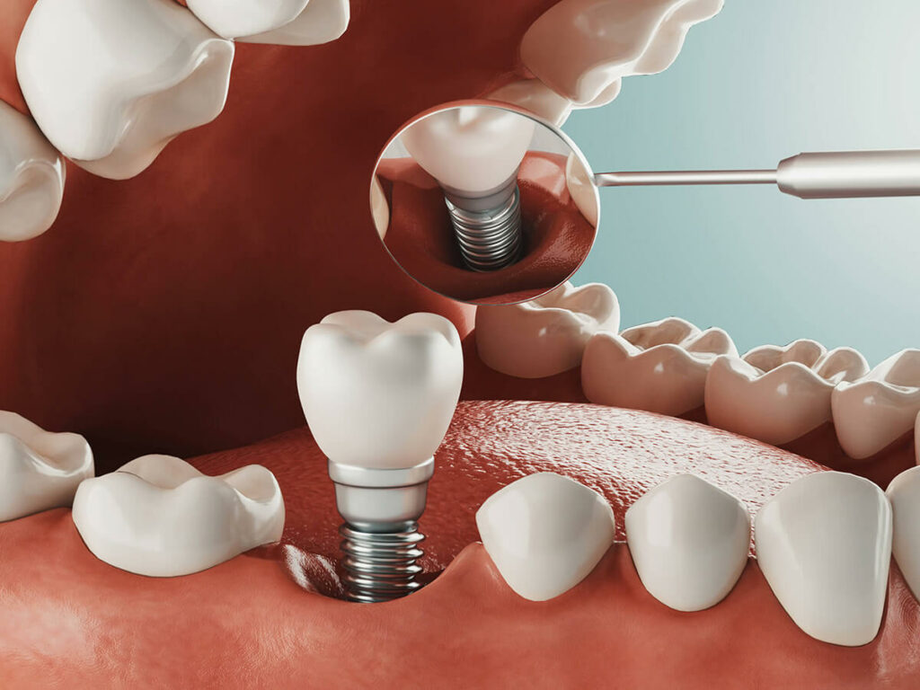 Graphic of a dental implant being placed in the socket.