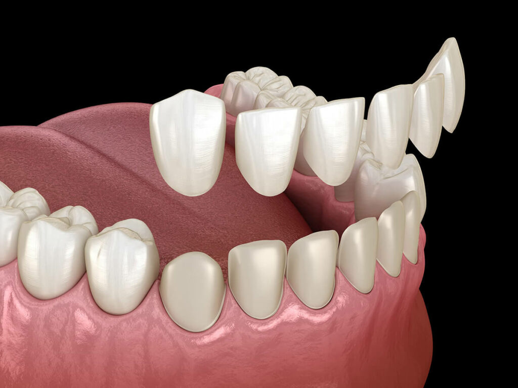 Graphic showing veneers being placed on top of teeth