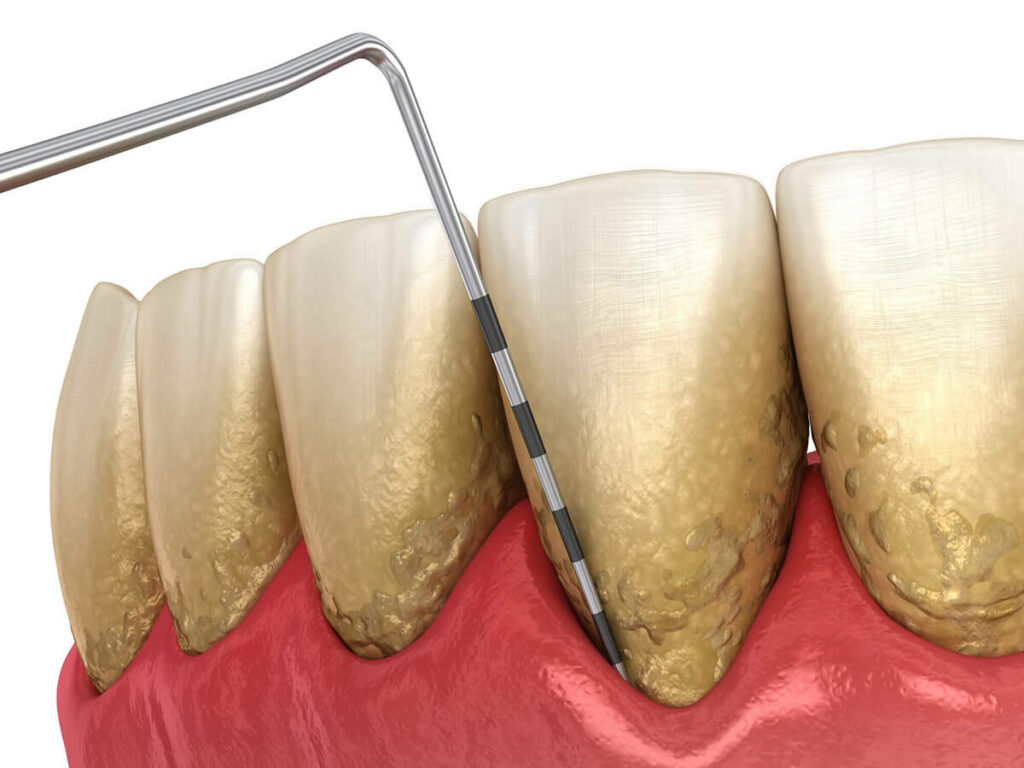 Graphic showing massive plaque and tartar buildup on a row of teeth.
