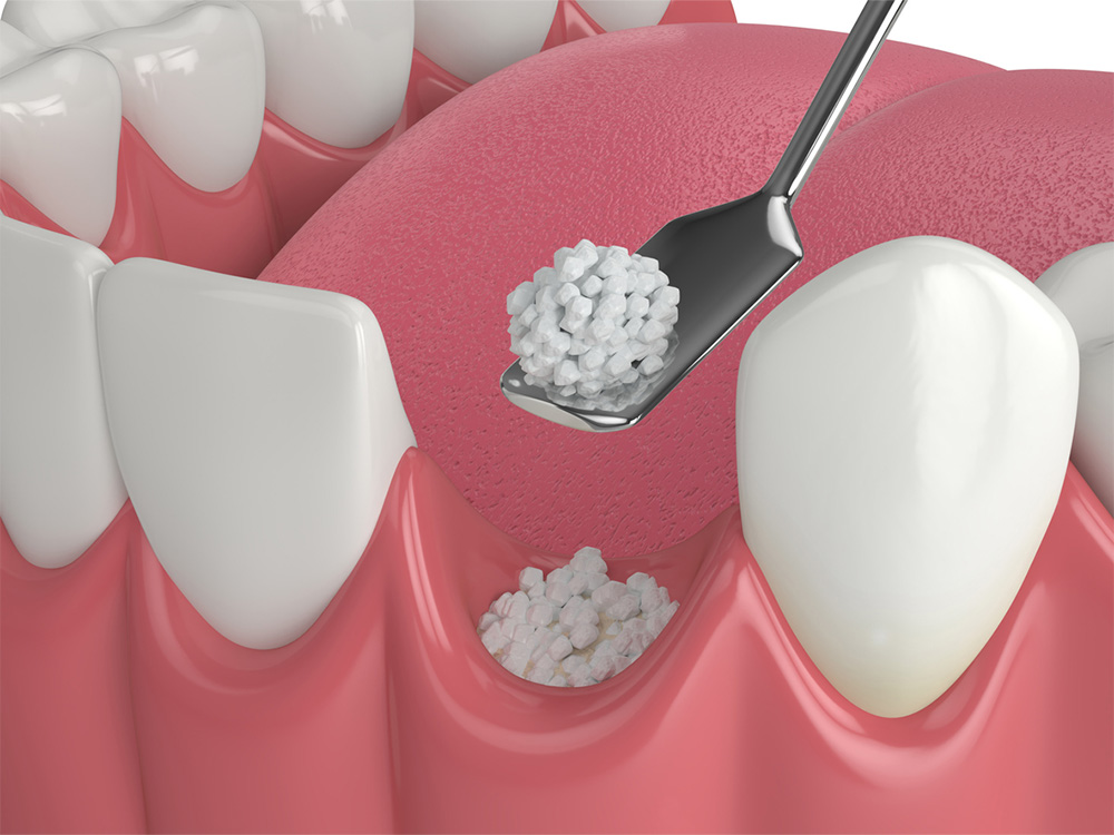 Graphic showing a bone grafting procedure.