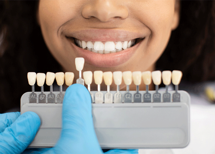Tooth color swatches next to a patient's mouth.