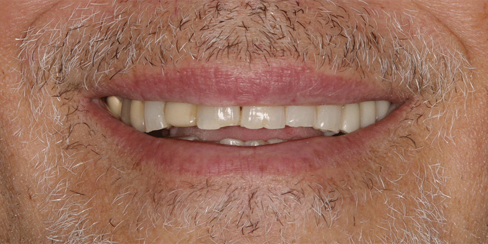 Patient five's pre-operation smile.
